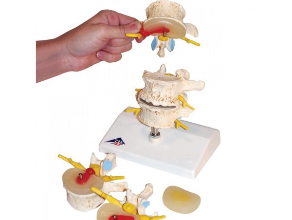 Evolution Hernie Discale et Dégénérescence Vertébrale Evolution Hernie Discale et Dégénérescence Vertébrale