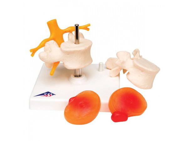 Modèle de Vertèbres Lombaires avec Prolapsus des Disques Intervertébraux Modèle de Vertèbres Lombaires avec Prolapsus des Disques Intervertébraux