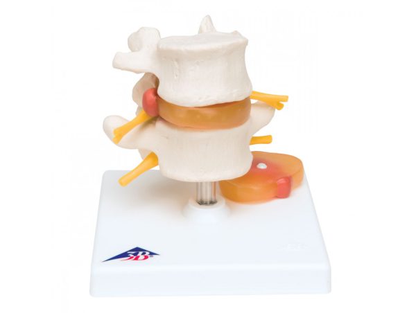 Modèle de Vertèbres Lombaires avec Prolapsus des Disques Intervertébraux Modèle de Vertèbres Lombaires avec Prolapsus des Disques Intervertébraux