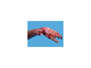 Fracture Ouverte du Poignet