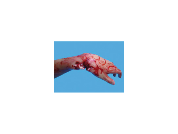 Fracture Ouverte du Poignet