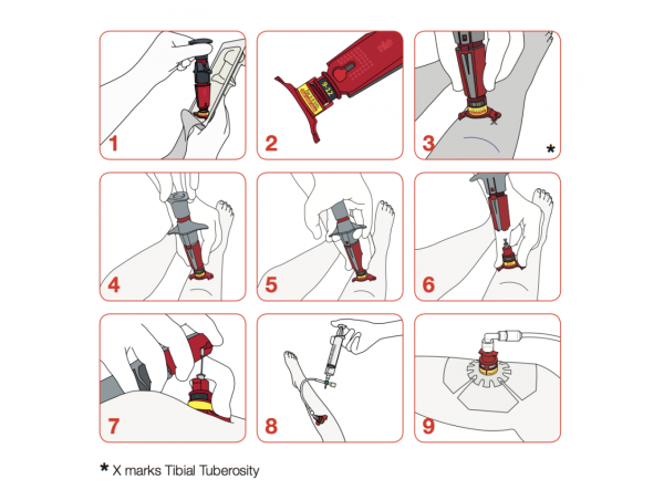 Injecteur Intra-Osseux NIO Pédiactric Injecteur Intra-Osseux NIO Pédiactric